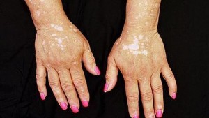 vitiligo--478x270