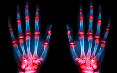 Artrosis y artritis: conoce sus diferencias y sus similitudes