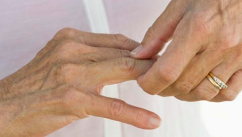 Ligan artritis reumatoide a factores genéticos y ambientales